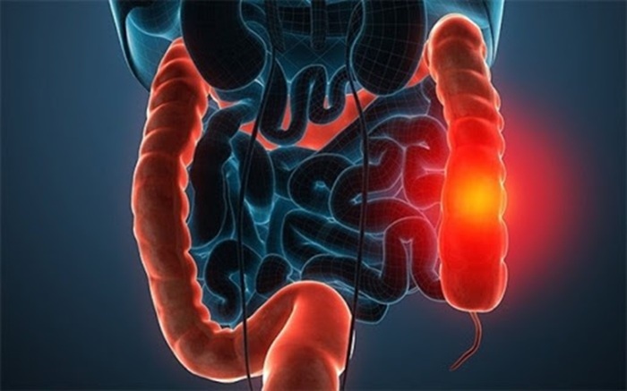 سرطان کولورکتال از شایع‌ترین سرطان‌ها در جهان و ایران است