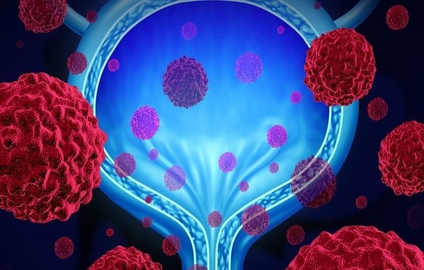 افزایش ابتلا به سرطان مثانه افزایش ابتلا به سرطان مثانه