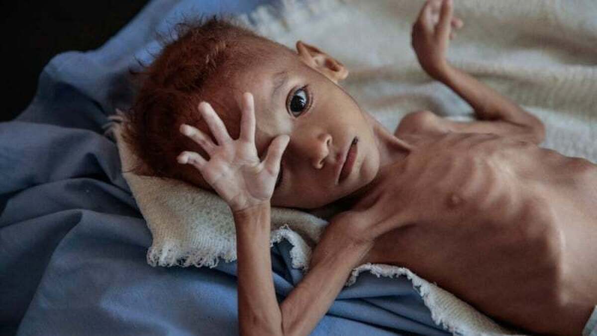 شهادت ۳ نفر در غزه در پی گرسنگی و سوء تغذیه